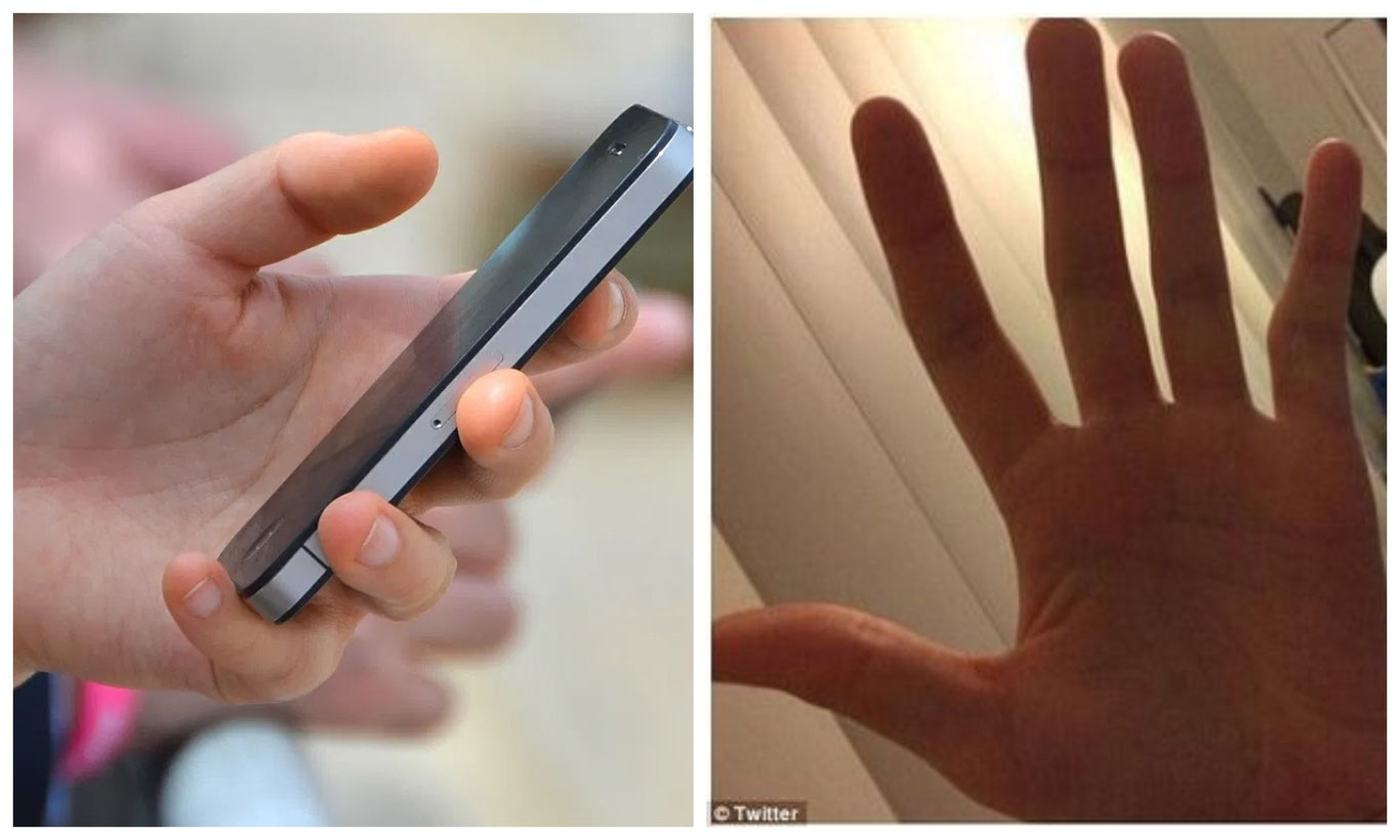 “Smart pinky”. Smartfon foydalanuvchilari orasida barmoqning deformatsiyasi kuchaymoqda