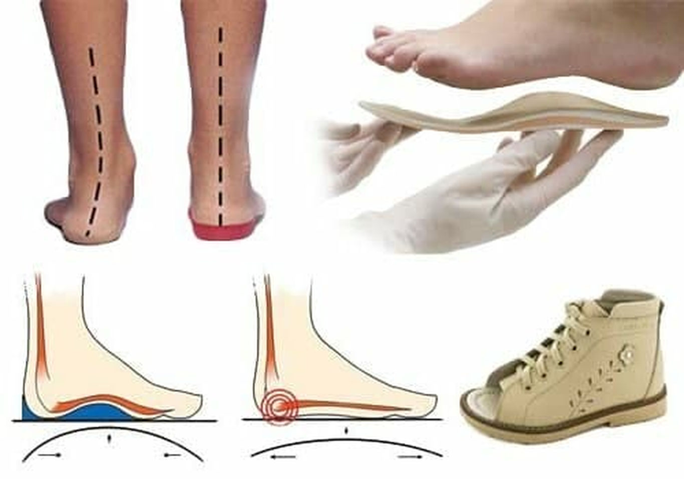 Qandli diabet bilan kasallangan bemorlar uchun ortopedik poyabzal ixtiro qilindi