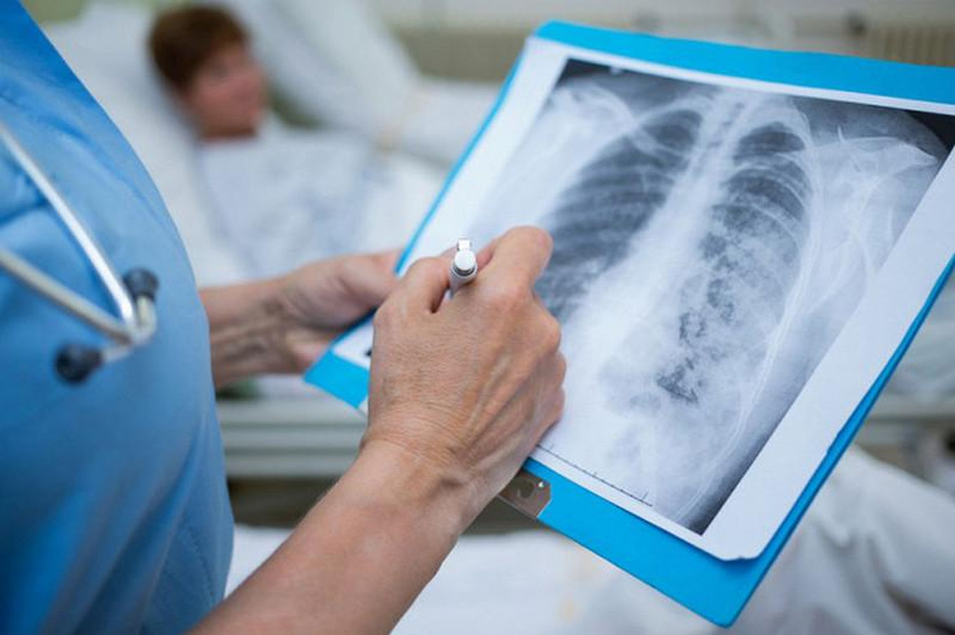 Пневмония билан курашаётган жами беморлар сони очиқланди