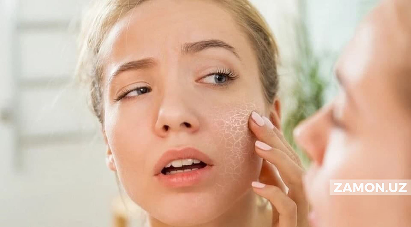 Юз терисининг кўчиши қандай касалликнинг белгиси эканлиги маълум бўлди