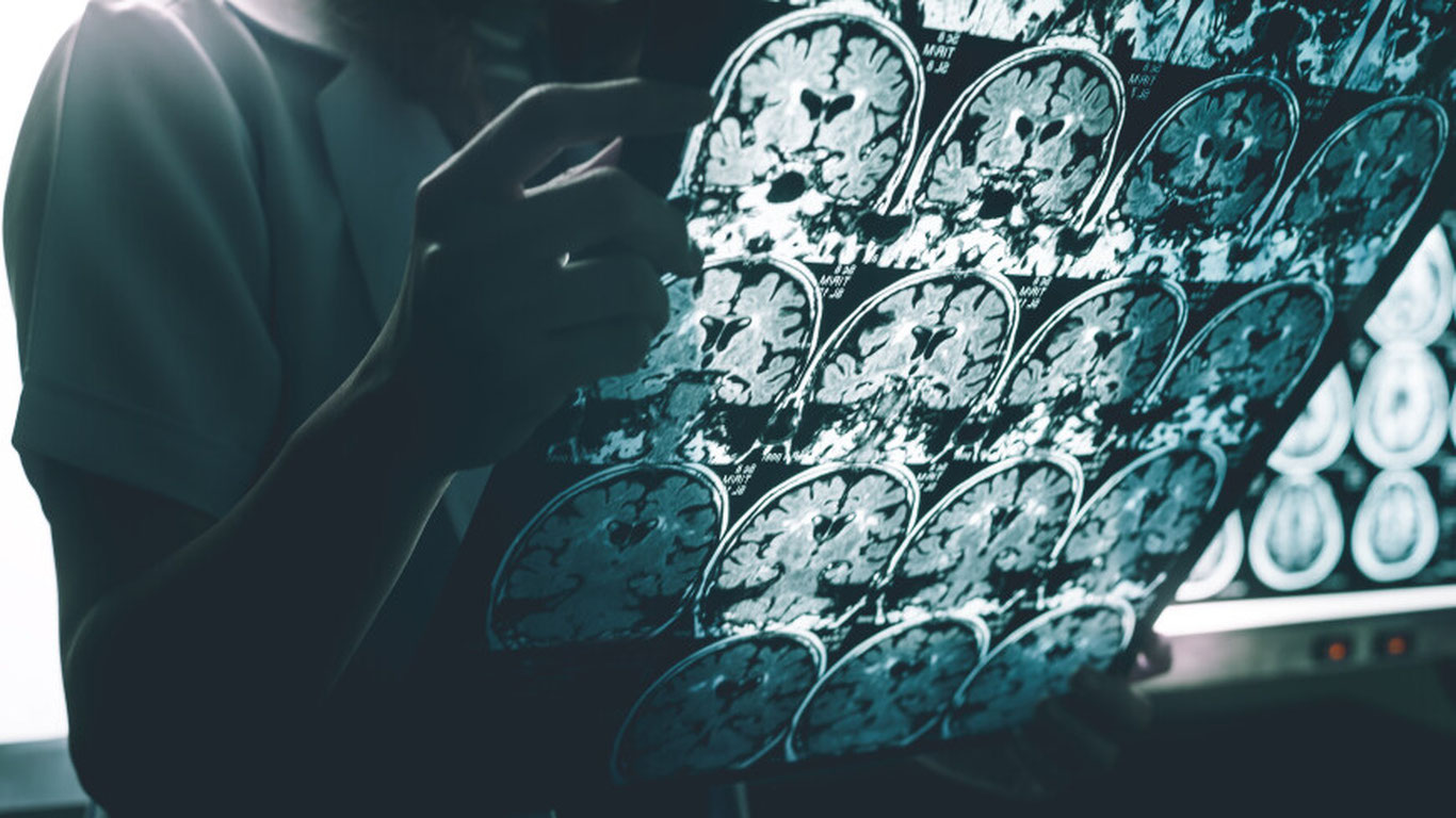 Энди Альцгеймер касаллигининг ривожланишини секинлатиш мумкин