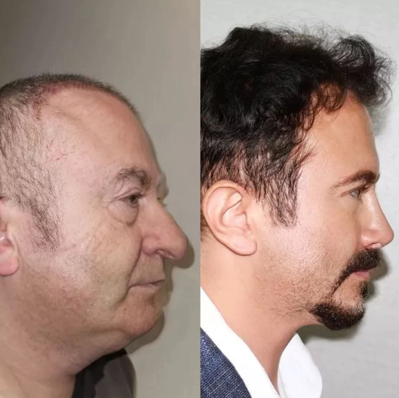 Turkiyalik erkak plastik operatsiya bilan 30 yoshga yoshardi