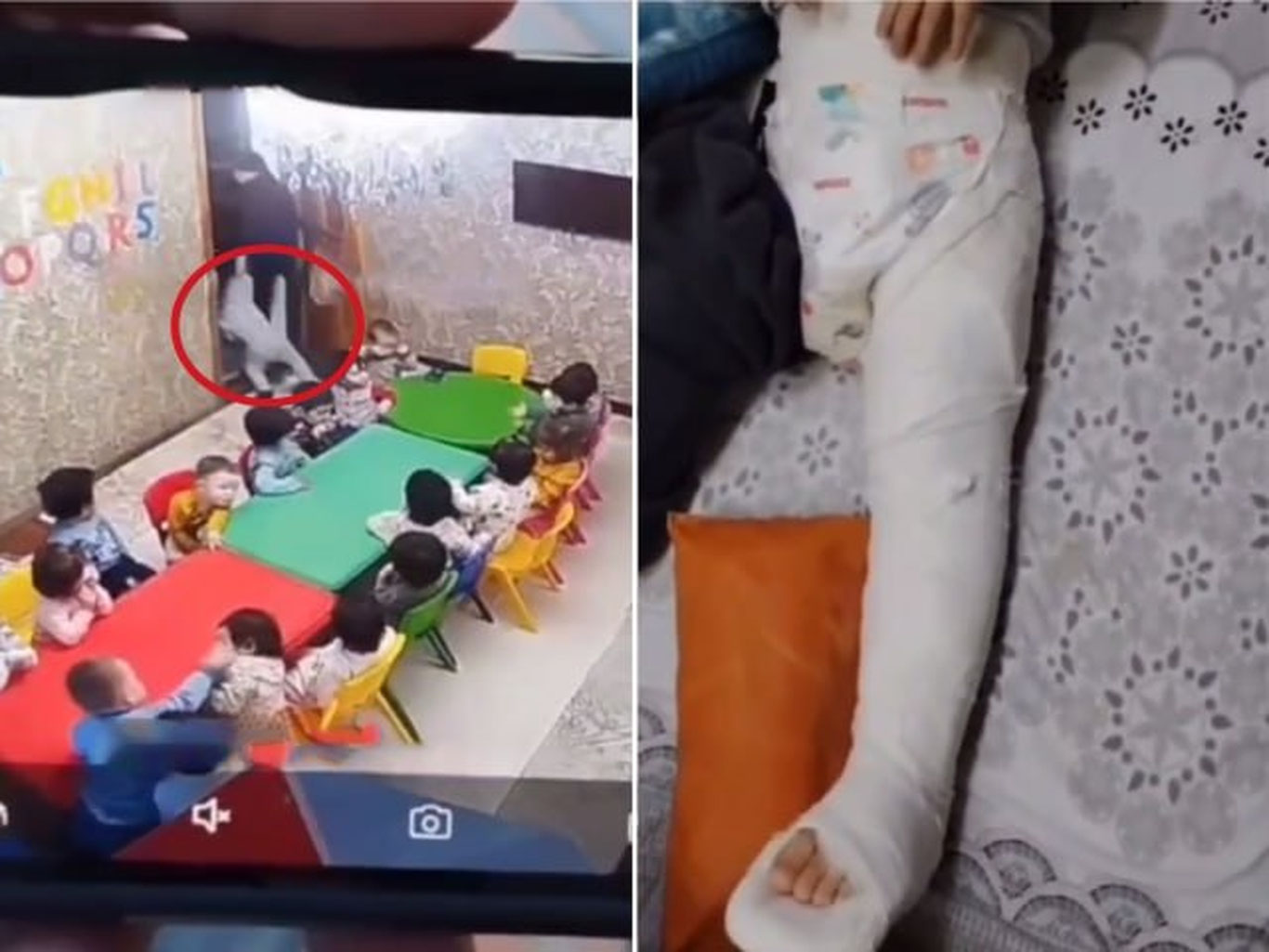 Тошкентдаги боғчада бола калтакланиши сабаб оёғи синди