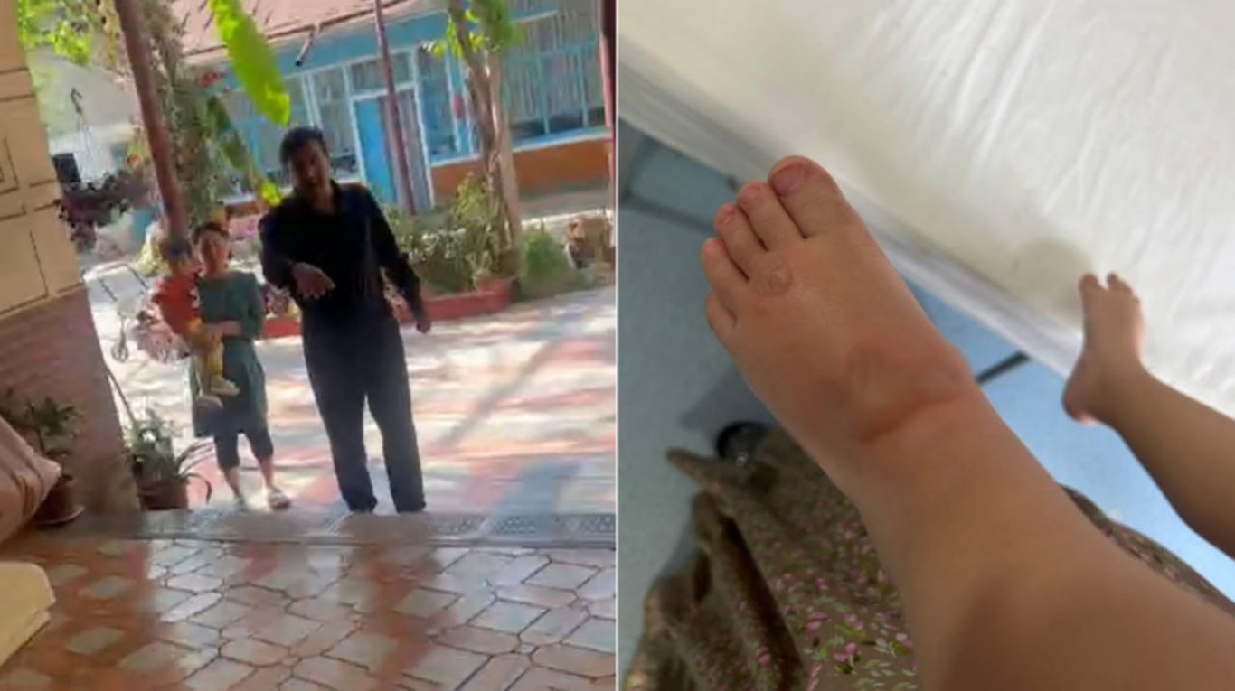 Намангандаги боғчада тарбиячи боланинг оёғини куйдириб қўйди