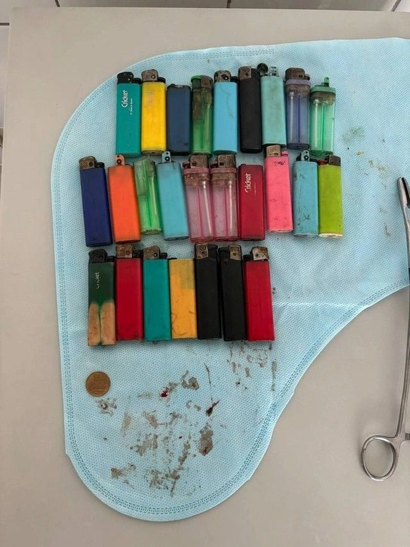 Россиялик беморнинг ошқозонидан 27 та зажигалка олиб ташланди