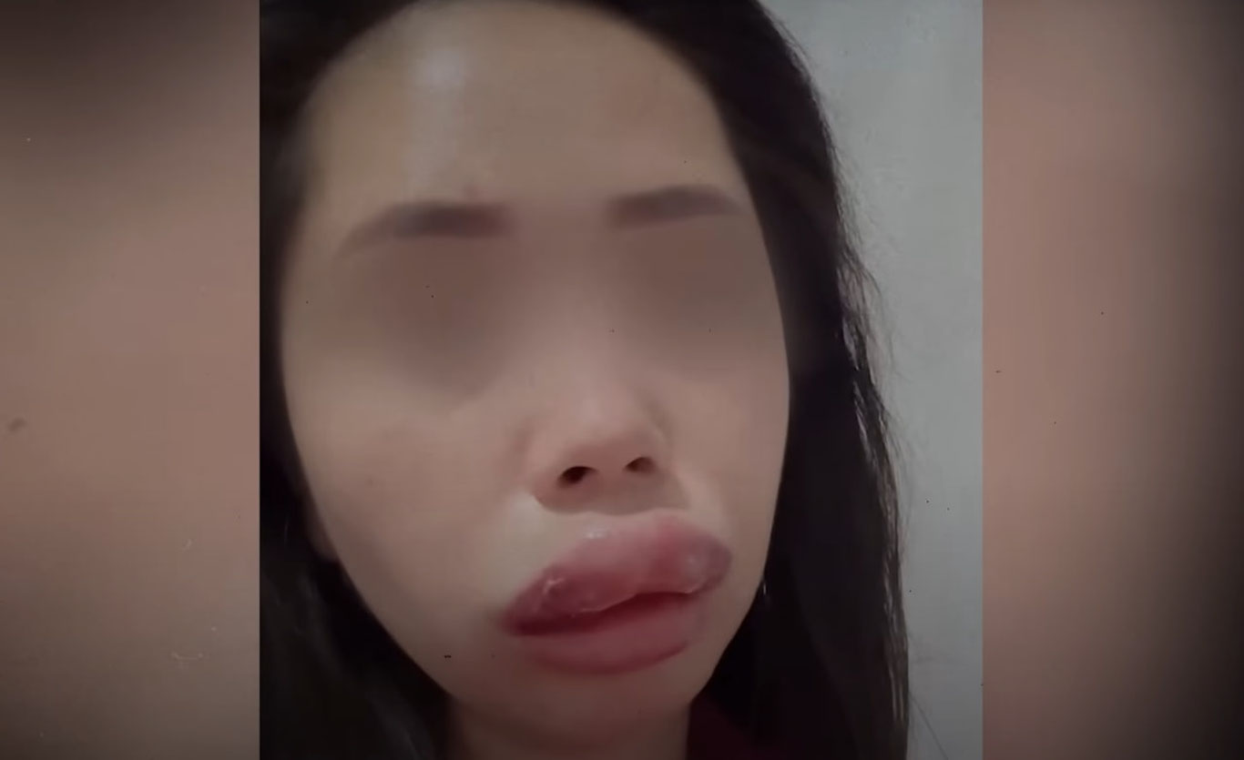 “Ayollarning yuz qismida o‘tkazilgan ayrim amaliyotlar noxush holatlarga olib kelayotgani — fakt”