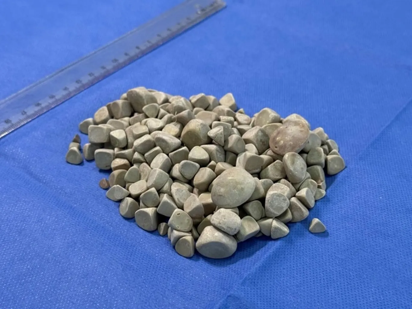 Туркияда 21 ёшли қизнинг танасидан 287 та тош олиб ташланди