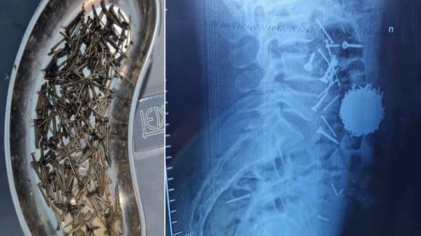 Самарқандда эркак 200 граммга яқин михни ютиб юборди